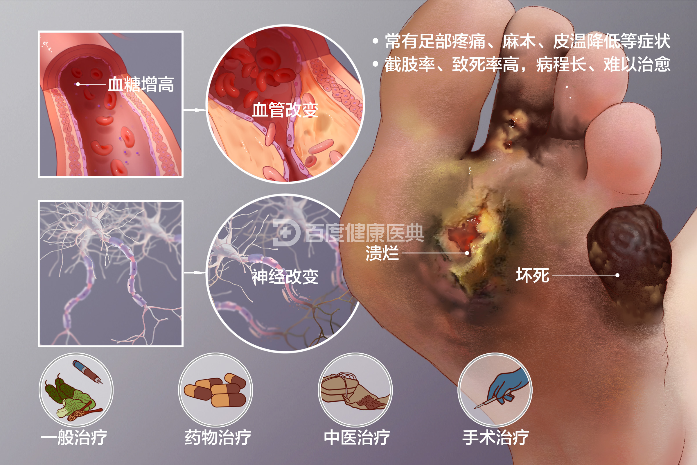 糖尿病足