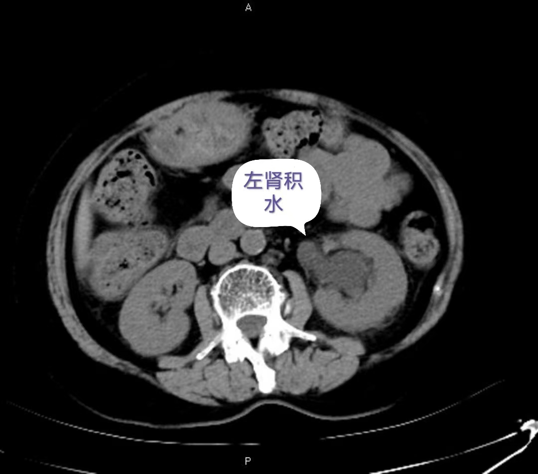 盆腔ct平扫示:1,左侧输尿管腹段结石,上游输尿管,左肾盂肾盏扩张积水