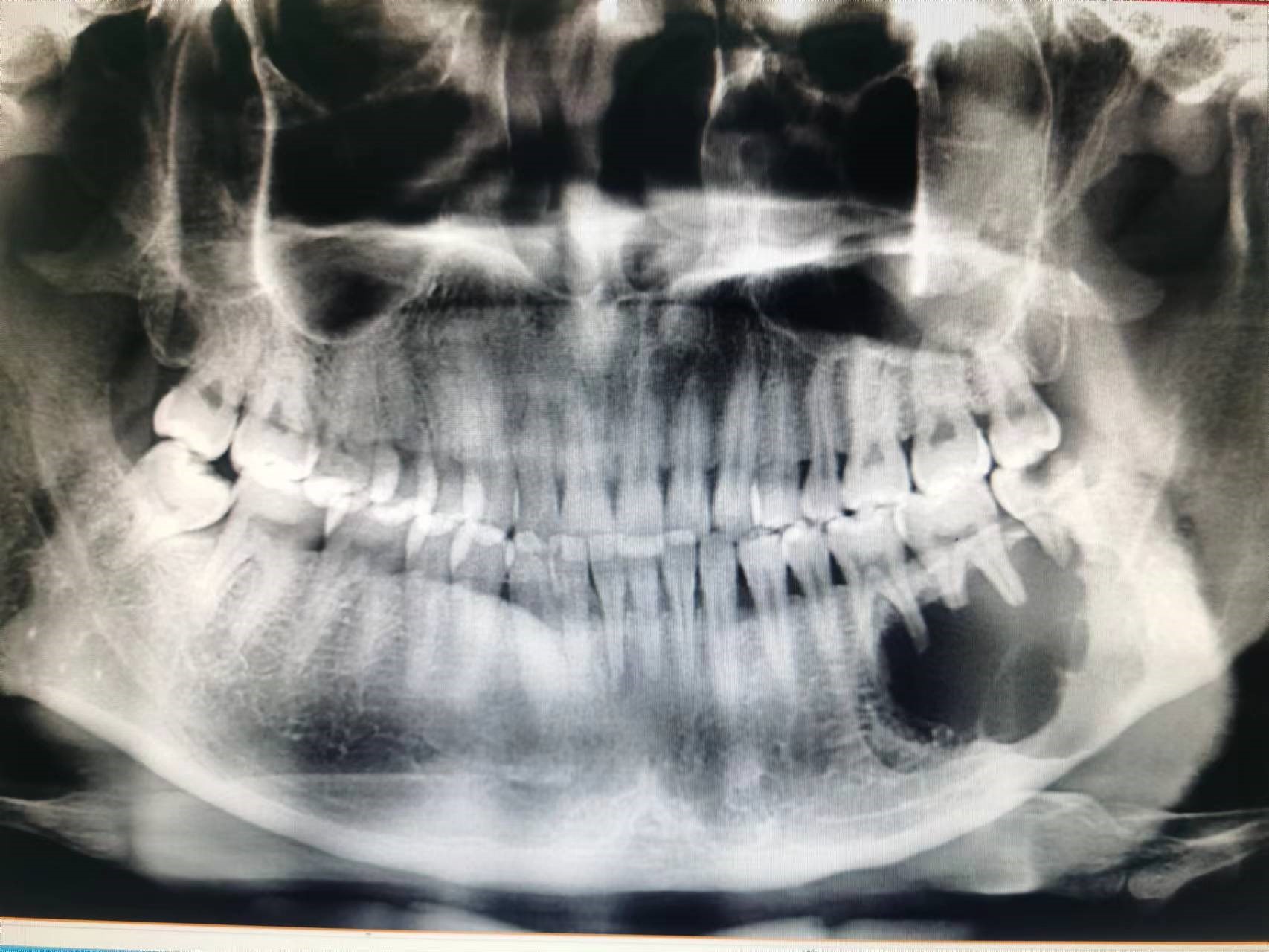 第一节 牙源性中央性颌骨骨髓炎-临床医学-医学